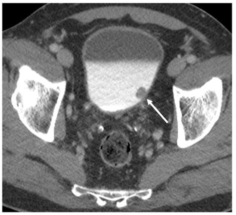 lv y et al 2012|Narrow band imaging diagnosis of bladder cancer: systematic .